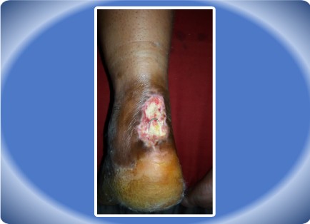 TENDO ACHILLES INJURY